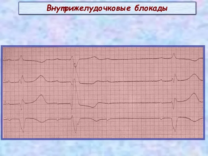 Внутрижелудочковые блокады