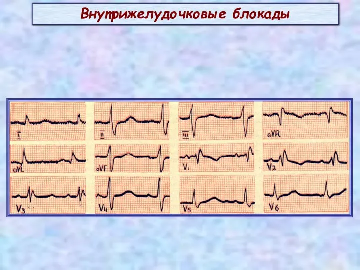 Внутрижелудочковые блокады