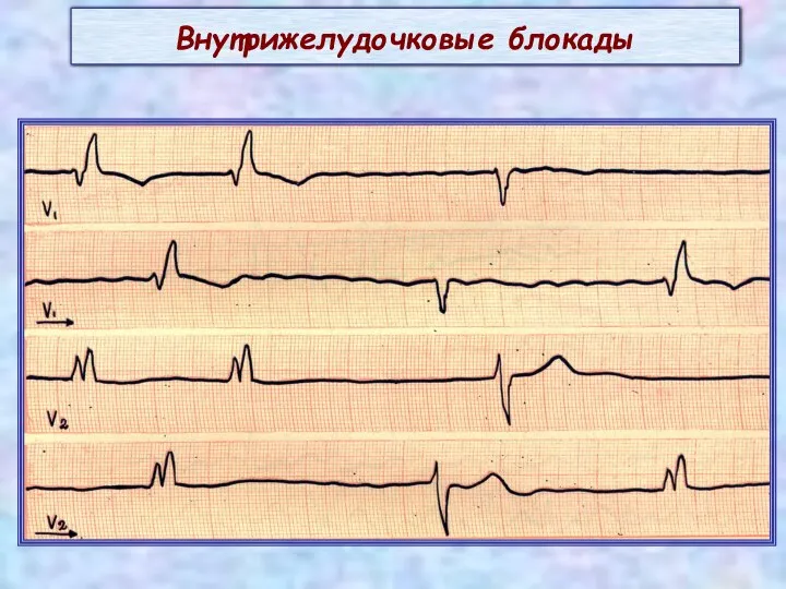 Внутрижелудочковые блокады