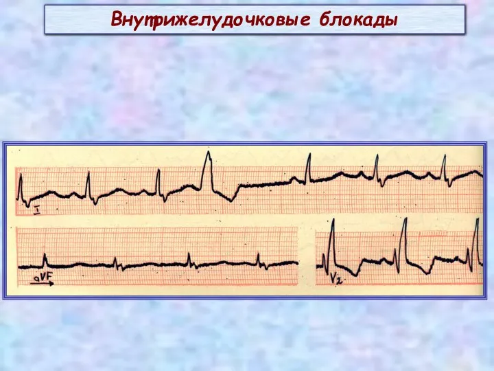 Внутрижелудочковые блокады