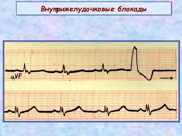 Внутрижелудочковые блокады