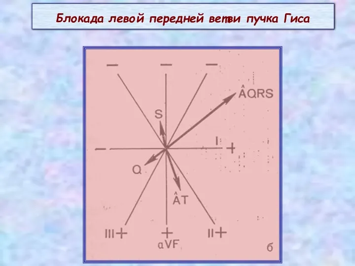 Блокада левой передней ветви пучка Гиса