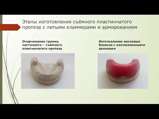 Этапы изготовления съёмного пластинчатого протеза с литыми кламмерами и армированием Очерчивание