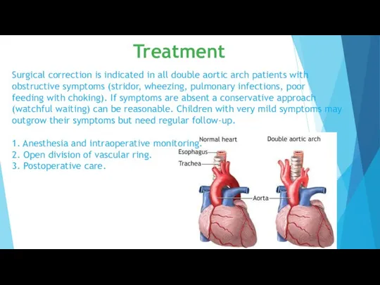 Surgical correction is indicated in all double aortic arch patients with