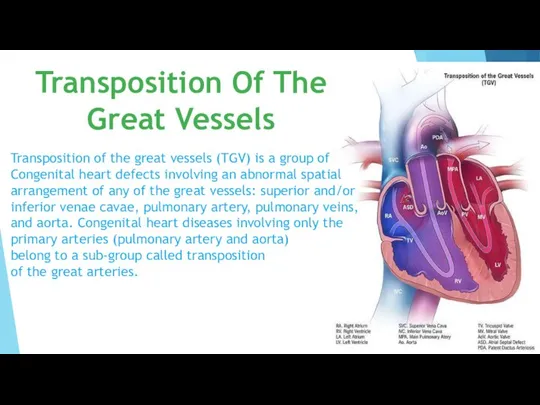 Transposition of the great vessels (TGV) is a group of Congenital