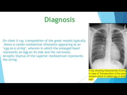 On chest X-ray, transposition of the great vessels typically shows a