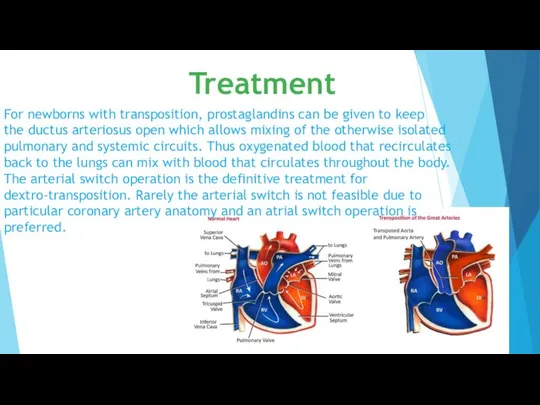 Treatment For newborns with transposition, prostaglandins can be given to keep