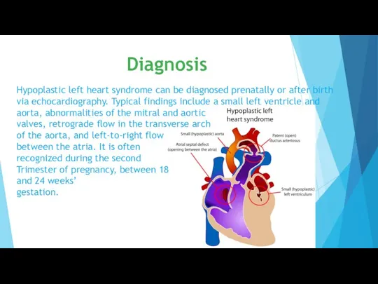 Hypoplastic left heart syndrome can be diagnosed prenatally or after birth