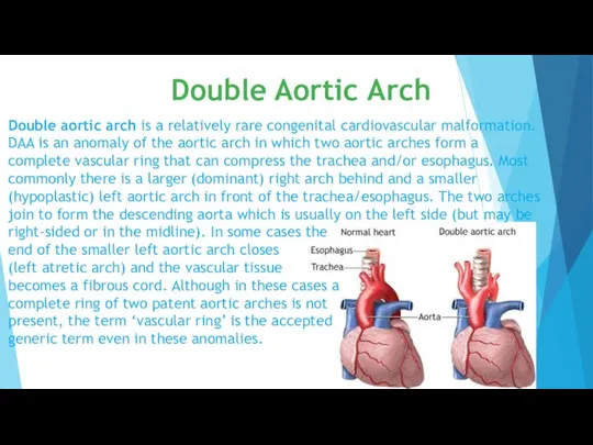 Double aortic arch is a relatively rare congenital cardiovascular malformation. DAA