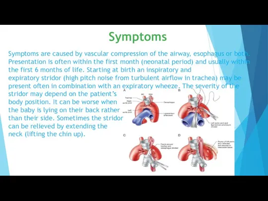 Symptoms are caused by vascular compression of the airway, esophagus or