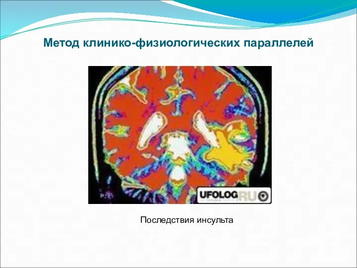 Метод клинико-физиологических параллелей Последствия инсульта