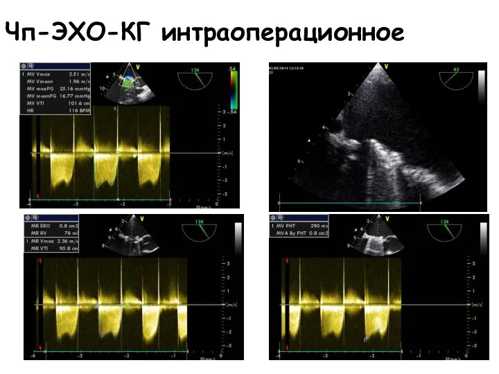 Чп-ЭХО-КГ интраоперационное