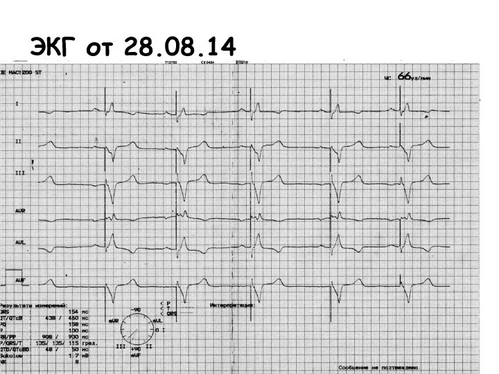 ЭКГ от 28.08.14