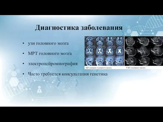 Диагностика заболевания узи головного мозга МРТ головного мозга электронейромиография Часто требуется консультация генетика