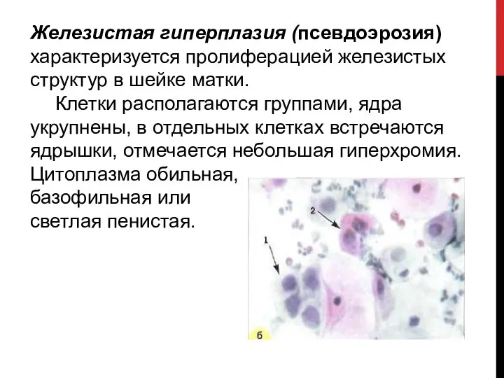 Железистая гиперплазия (псевдоэрозия) характеризуется пролиферацией железистых структур в шейке матки. Клетки