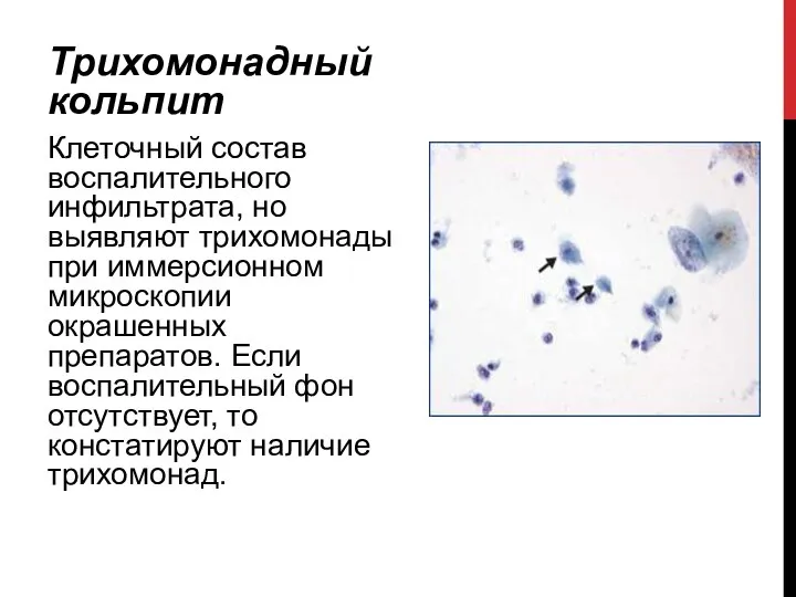 Трихомонадный кольпит Клеточный состав воспалительного инфильтрата, но выявляют трихомонады при иммерсионном