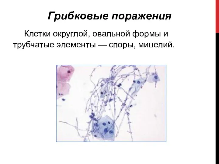 Грибковые поражения Клетки округлой, овальной формы и трубчатые элементы — споры, мицелий.