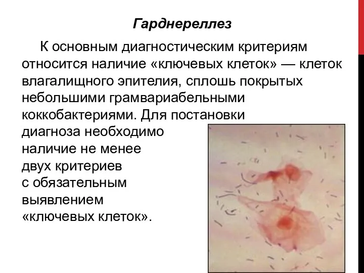 Гарднереллез К основным диагностическим критериям относится наличие «ключевых клеток» — клеток