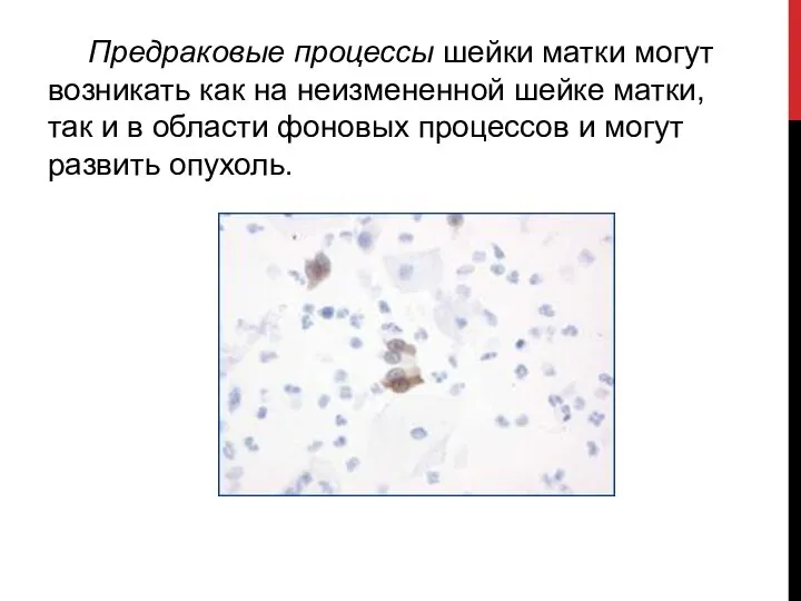 Предраковые процессы шейки матки могут возникать как на неизмененной шейке матки,