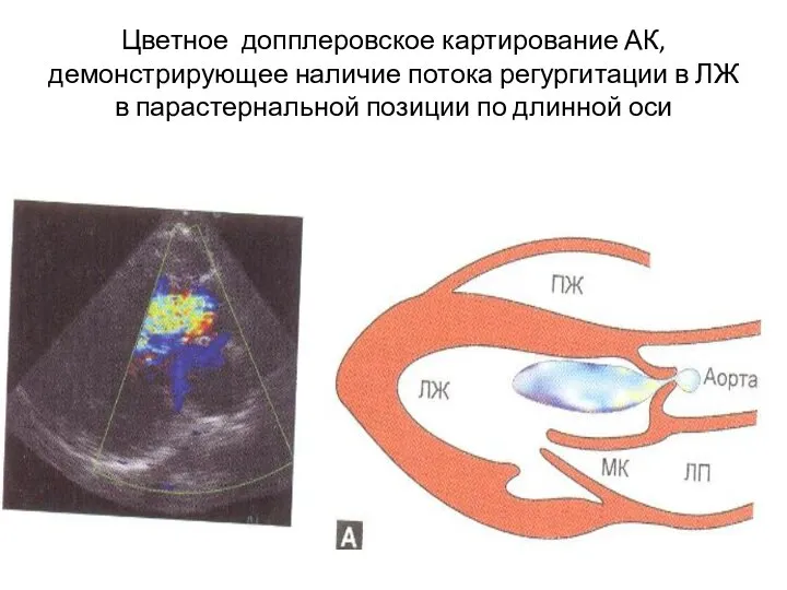 Цветное допплеровское картирование АК, демонстрирующее наличие потока регургитации в ЛЖ в парастернальной позиции по длинной оси