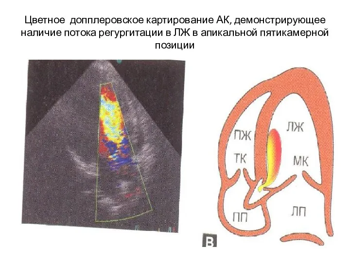 Цветное допплеровское картирование АК, демонстрирующее наличие потока регургитации в ЛЖ в апикальной пятикамерной позиции