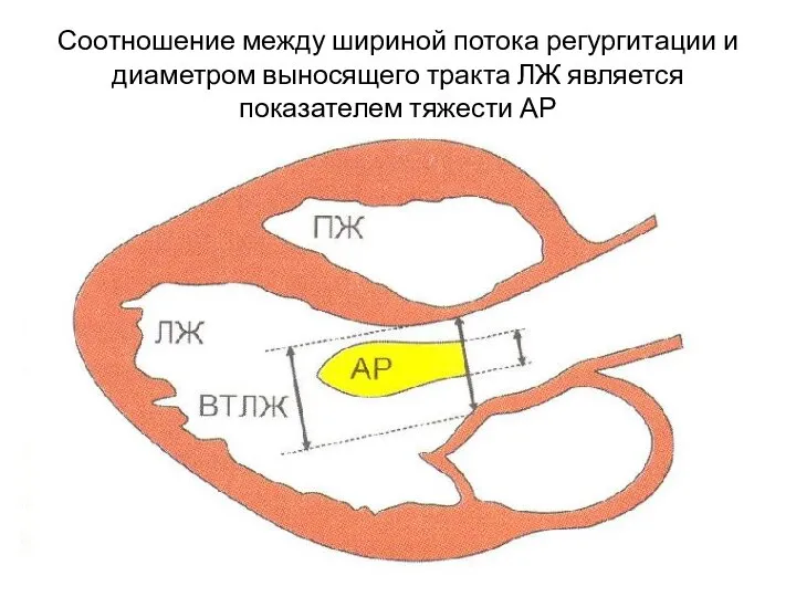 Соотношение между шириной потока регургитации и диаметром выносящего тракта ЛЖ является показателем тяжести АР