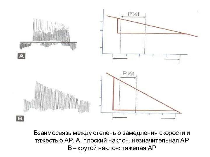 Взаимосвязь между степенью замедления скорости и тяжестью АР. А- плоский наклон: