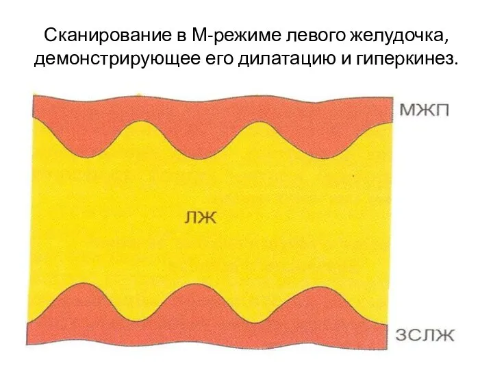 Сканирование в М-режиме левого желудочка, демонстрирующее его дилатацию и гиперкинез.