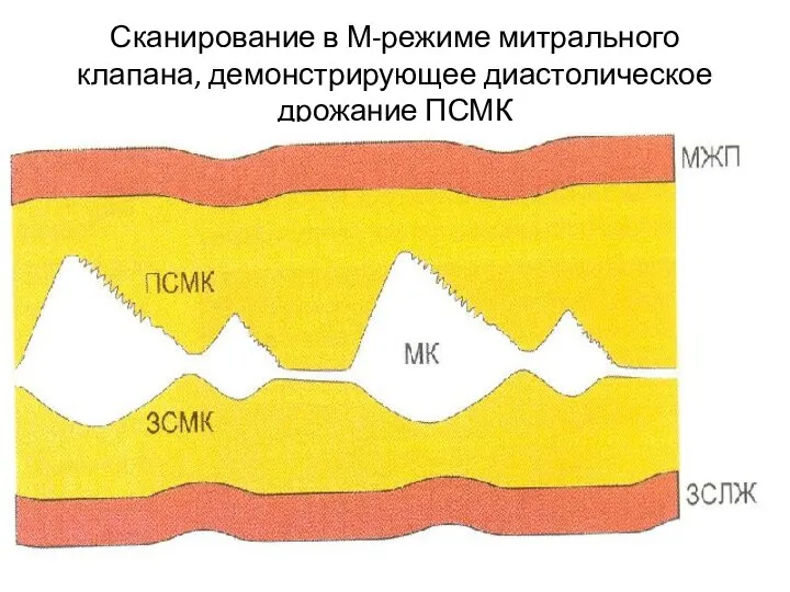 Сканирование в М-режиме митрального клапана, демонстрирующее диастолическое дрожание ПСМК