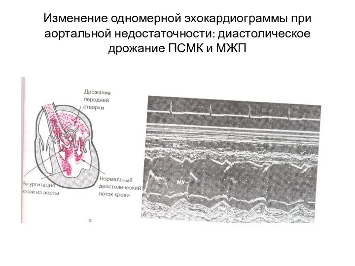 Изменение одномерной эхокардиограммы при аортальной недостаточности: диастолическое дрожание ПСМК и МЖП