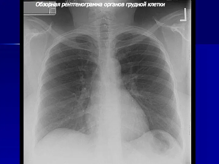Обзорная рентгенограмма органов грудной клетки