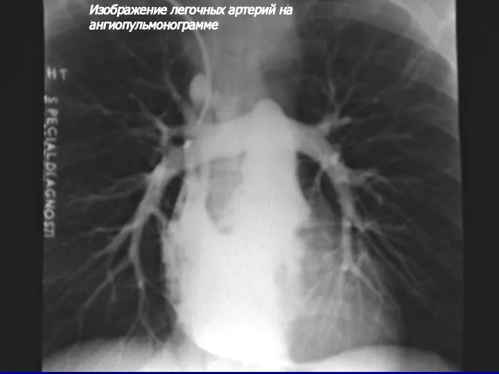 Изображение легочных артерий на ангиопульмонограмме