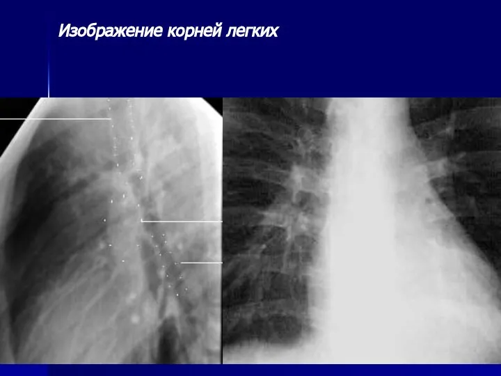 Изображение корней легких