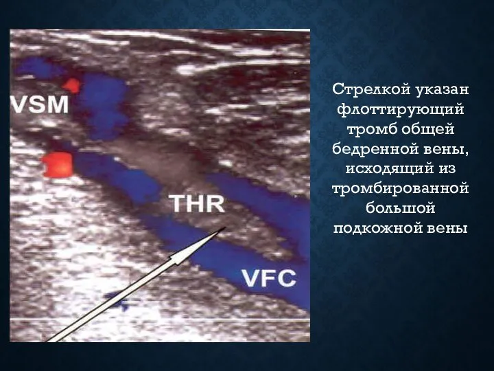 Стрелкой указан флоттирующий тромб общей бедренной вены, исходящий из тромбированной большой подкожной вены