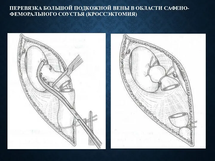 ПЕРЕВЯЗКА БОЛЬШОЙ ПОДКОЖНОЙ ВЕНЫ В ОБЛАСТИ САФЕНО-ФЕМОРАЛЬНОГО СОУСТЬЯ (КРОССЭКТОМИЯ)