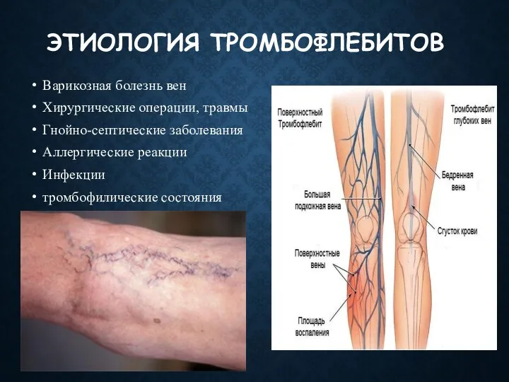 ЭТИОЛОГИЯ ТРОМБОФЛЕБИТОВ Варикозная болезнь вен Хирургические операции, травмы Гнойно-септические заболевания Аллергические реакции Инфекции тромбофилические состояния