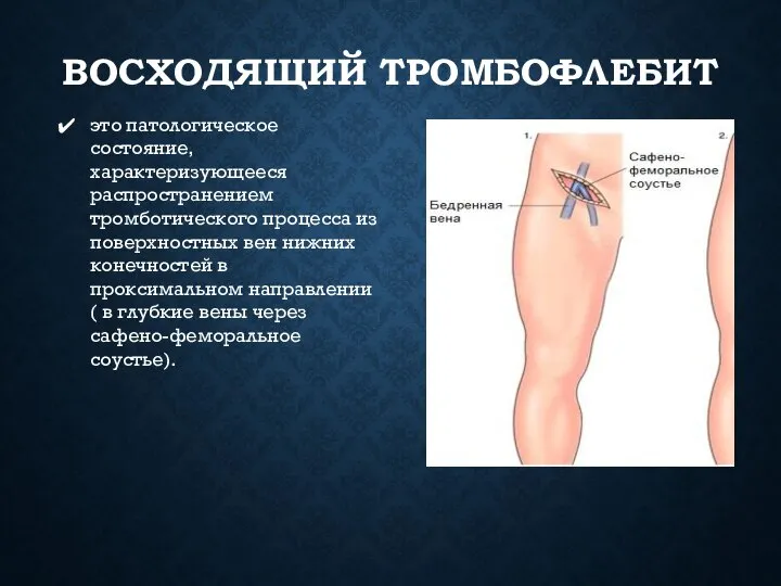 ВОСХОДЯЩИЙ ТРОМБОФЛЕБИТ это патологическое состояние, характеризующееся распространением тромботического процесса из поверхностных