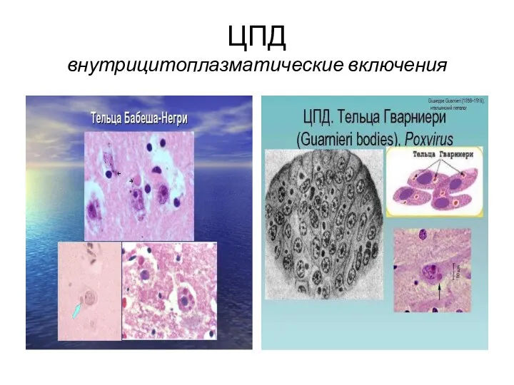 ЦПД внутрицитоплазматические включения