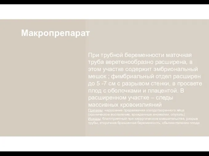 Макропрепарат При трубной беременности маточная труба веретенообразно расширена, в этом участке