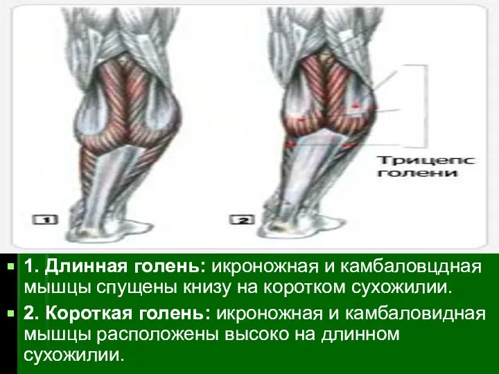 1. Длинная голень: икроножная и камбаловцдная мышцы спущены книзу на коротком
