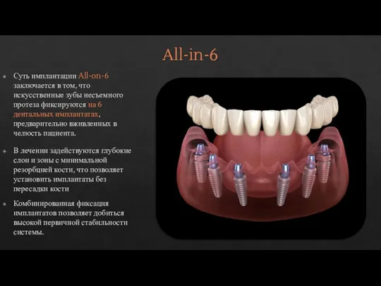All-in-6 Суть имплантации All-on-6 заключается в том, что искусственные зубы несъемного