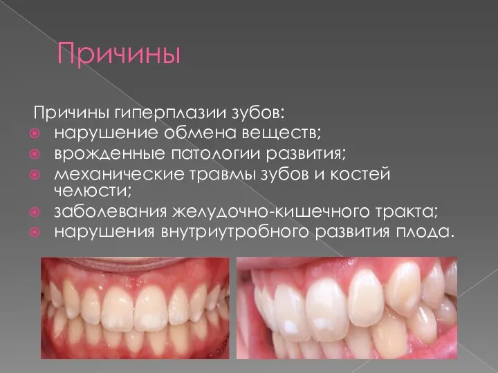 Причины Причины гиперплазии зубов: нарушение обмена веществ; врожденные патологии развития; механические
