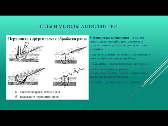 ВИДЫ И МЕТОДЫ АНТИСЕПТИКИ. Механическая антисептика – в основе лежит механический