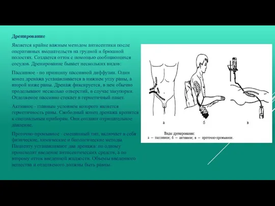 Дренирование Является крайне важным методом антисептики после оперативных вмешательств на грудной