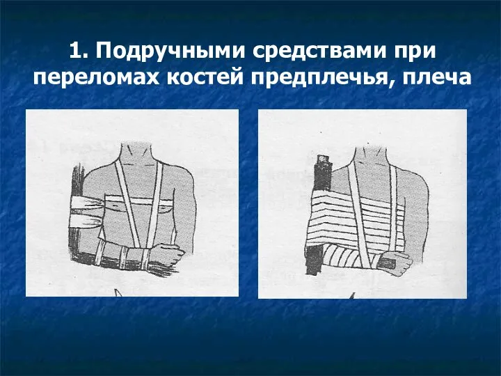 1. Подручными средствами при переломах костей предплечья, плеча