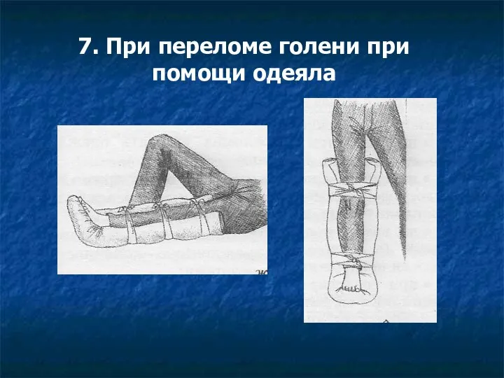 7. При переломе голени при помощи одеяла