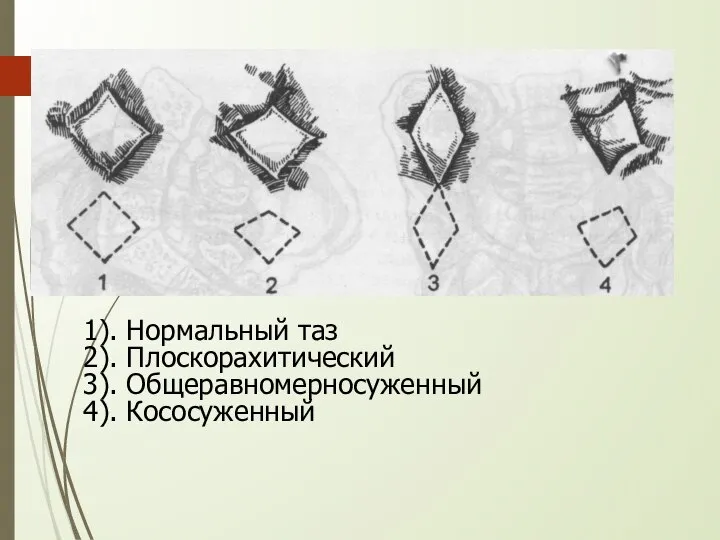 1). Нормальный таз 2). Плоскорахитический 3). Общеравномерносуженный 4). Кососуженный