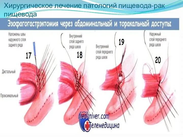 Хирургическое лечение патологий пищевода-рак пищевода