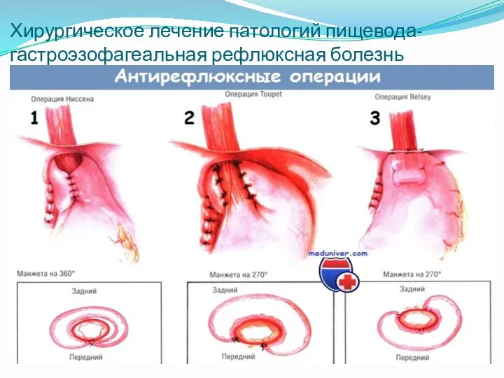 Хирургическое лечение патологий пищевода-гастроэзофагеальная рефлюксная болезнь