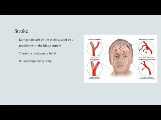 Stroke Damage to part of the brain caused by a problem